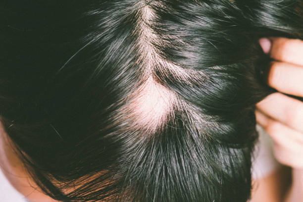 Does Alopecia Areata Treatment Really Work Fast?