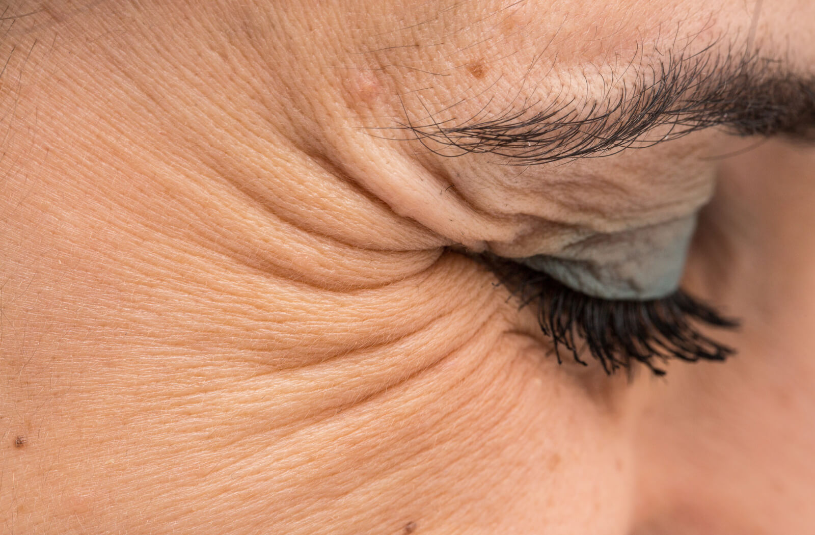 Does Wrinkle Treatment Reduce Crow’s Feet Too