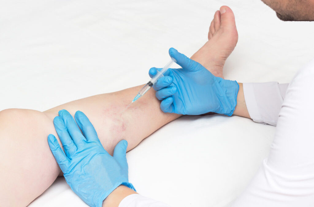 Effective Solutions for Spider Veins