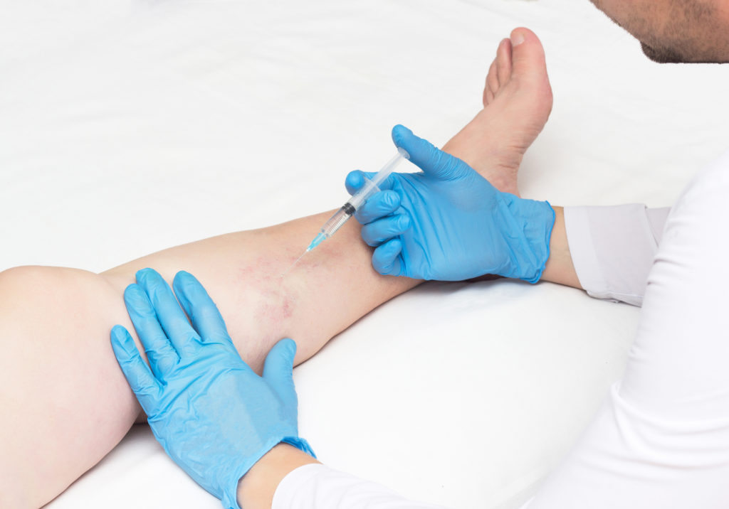 Effective Solutions for Spider Veins