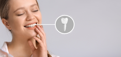 Full Mouth Dental Implants A Complete Smile Transformation