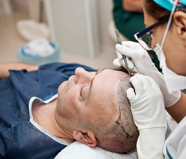 Hair Transplant in Riyadh (7)