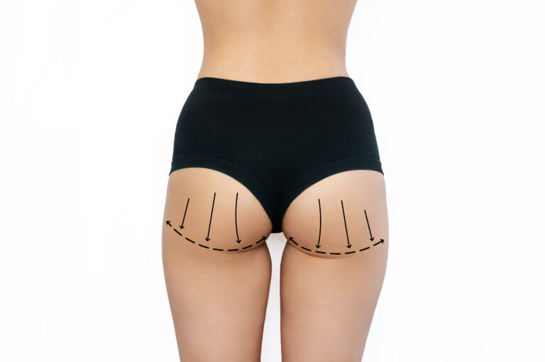 How Buttock Augmentation  Boosts Self-Image and Style