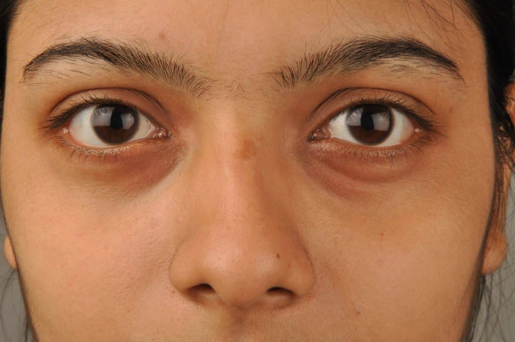 How Dark Circles Treatment Helps Tackle Eye Wrinkles