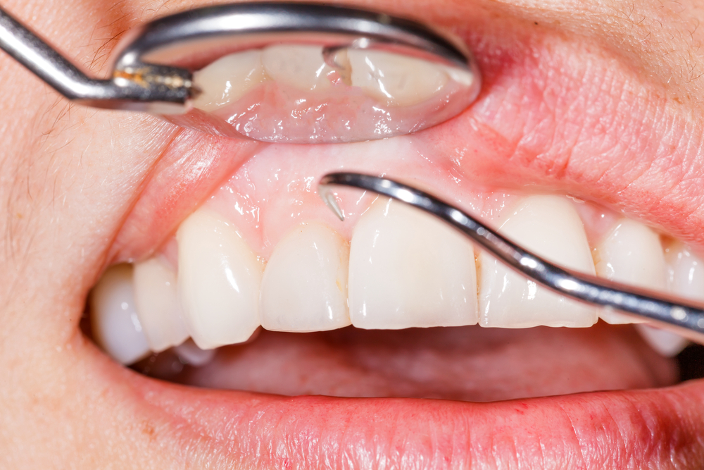 How Gingivectomy Improves Oral Hygiene and Gum Health