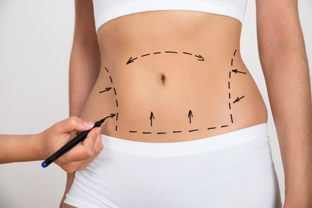 How Long Do Tummy Tuck Results Last Expert Answers Inside