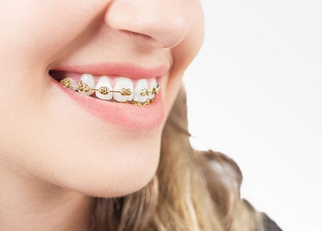 How Long Does Treatment with Metal Braces Take