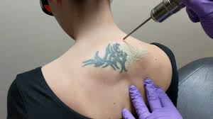 How Many Laser Tattoo Removal Sessions Will You Need