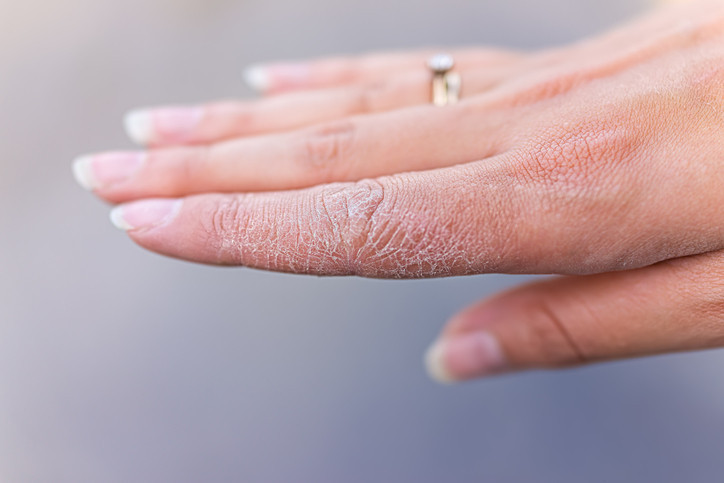 How Skin Diseases Treatment Helps Dry Skin Conditions