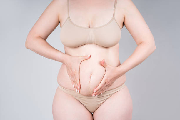 How Tummy Tuck Helps Reduce Skin Irritation from Folds