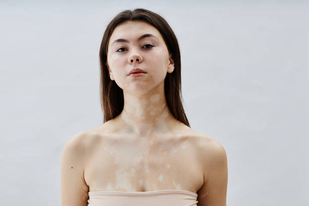 How Vitiligo Treatment Restores Even Skin Appearance ?