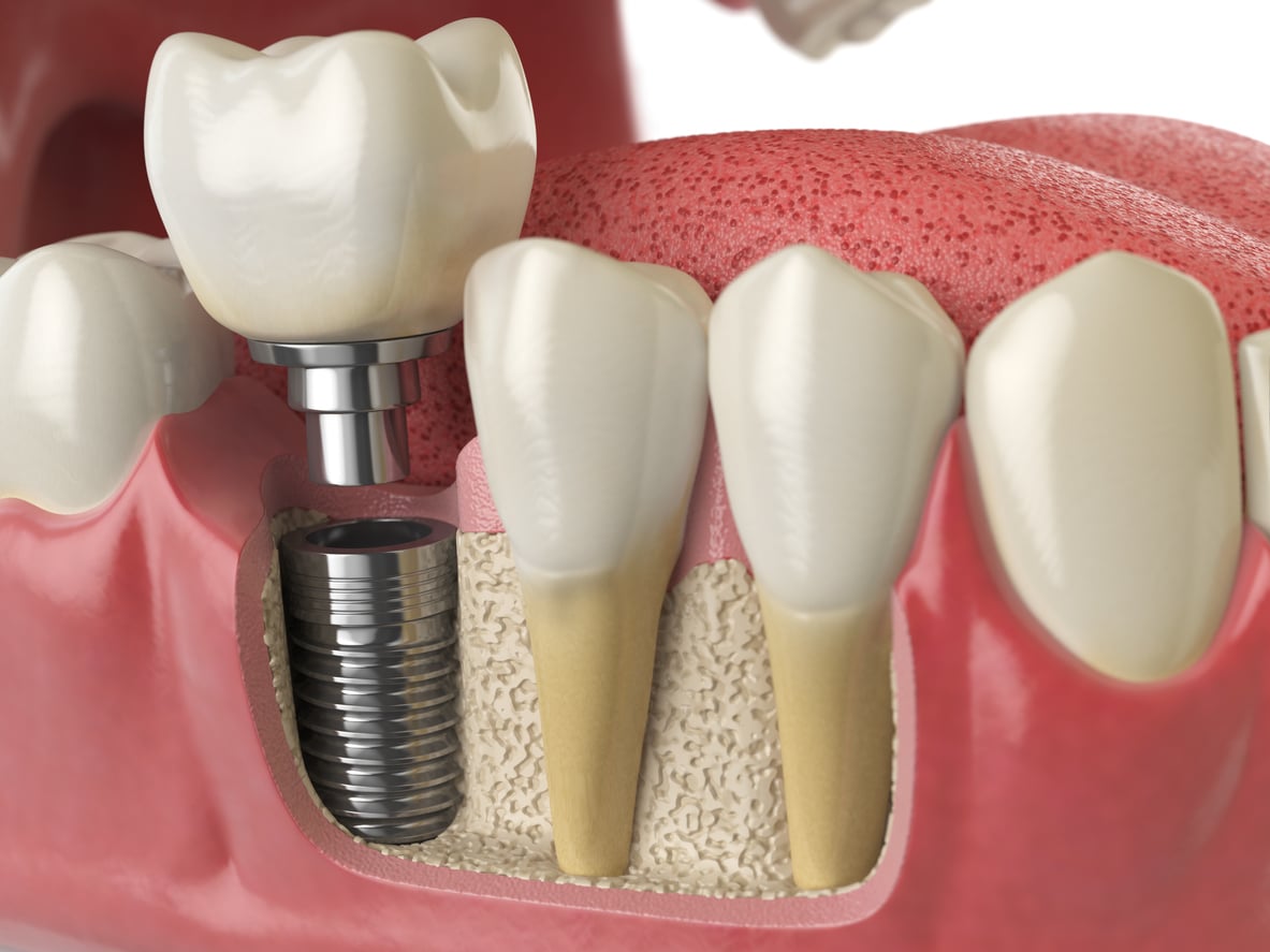 How to Care for Your Dental Implants Post-Surgery