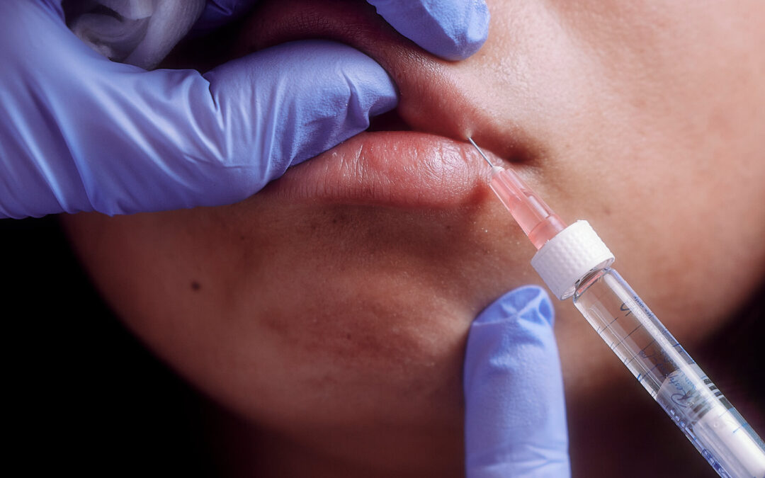 Lip Filler Techniques: Hyaluronic Acid and More