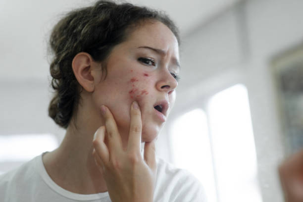 Is Acne Treatment Safe for Sensitive Skin Types