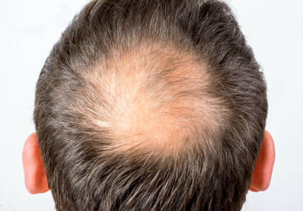 Is Crown Hair Transplant a Permanent Fix