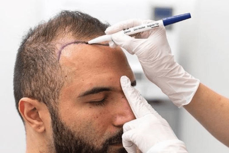 Is DHI Hair Transplant Safe for All Hair Types