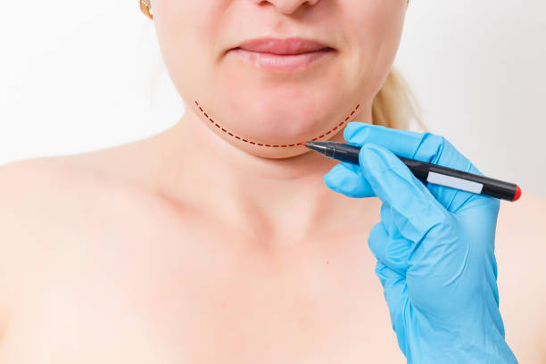 Is Double Chin Liposuction  a Permanent Fat Solution
