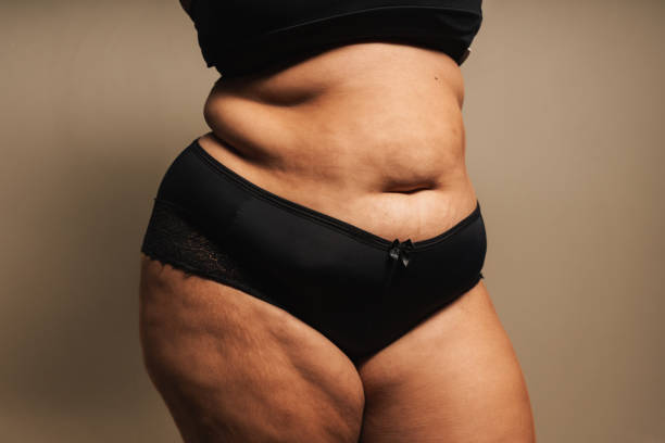 Is Tummy Tuck Surgery a Permanent Solution