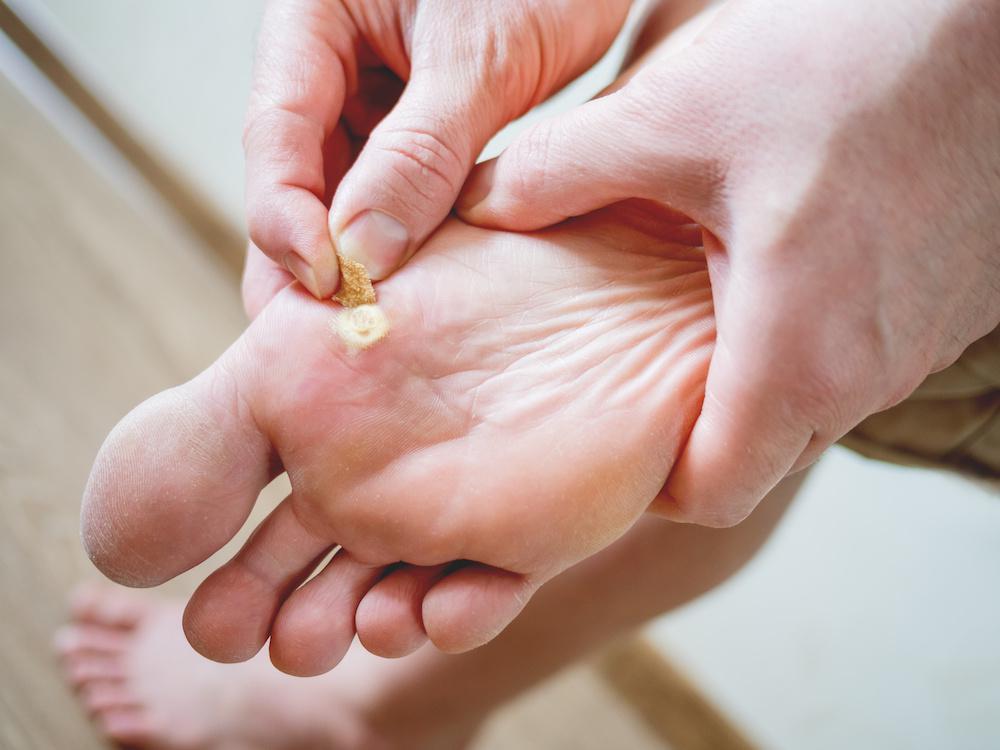 Is Warts Removal Treatment Good for All Ages
