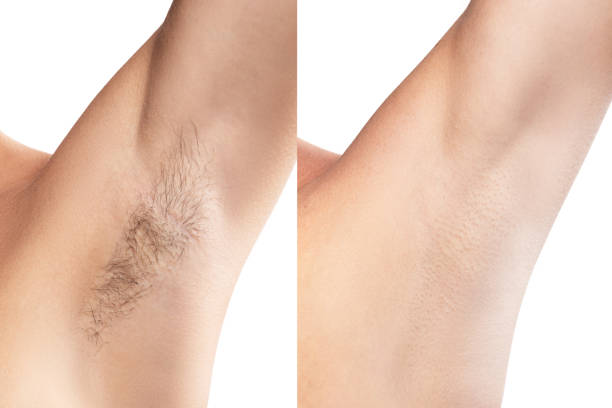 Skin Preparation Tips for Effective Laser Hair Removal Treatments