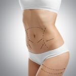 Liposuction Surgery in Riyadh
