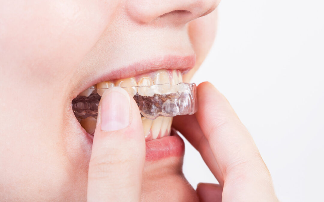 Mouthguards for Sleep Apnea: Can They Really Help?