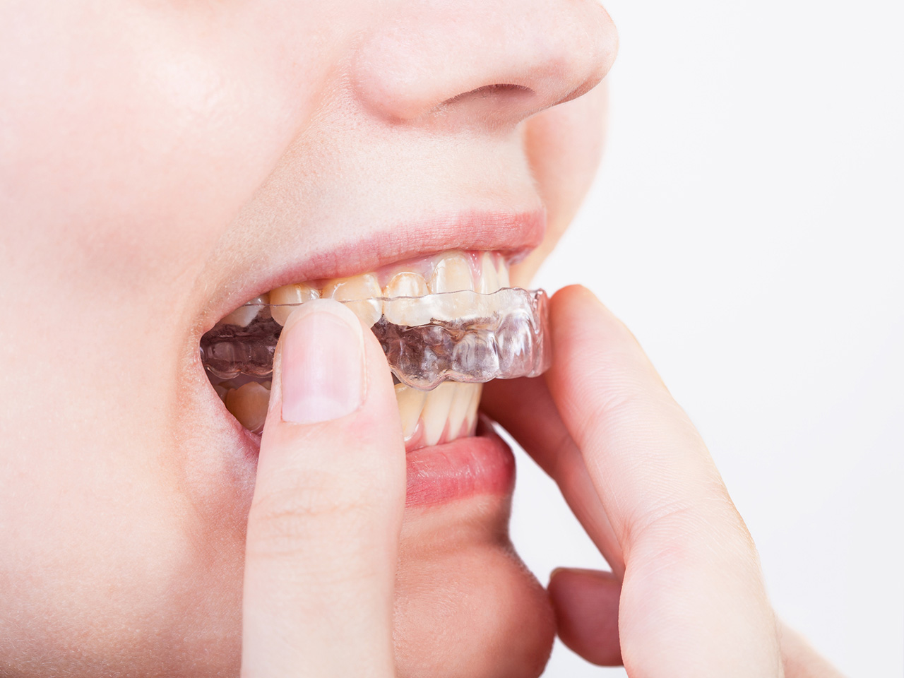 Mouthguards for Sleep Apnea Can They Really Help