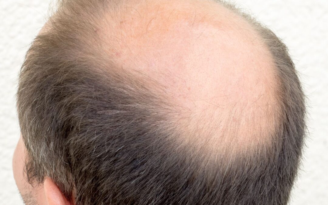 Renew Your Hair with Crown Hair Transplant