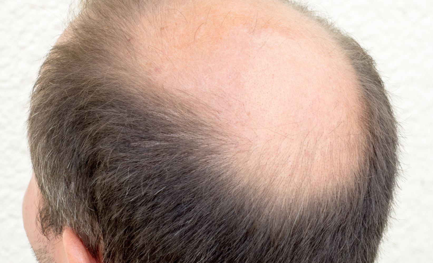 Renew Your Hair with Crown Hair Transplant