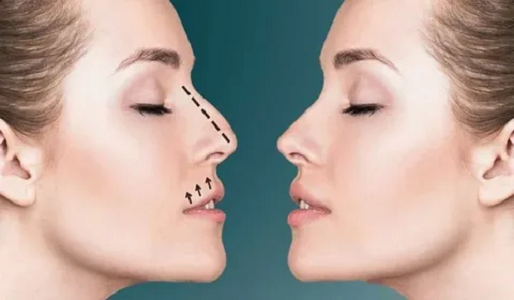 Unveil a New You with Rhinoplasty Surgery in Dubai