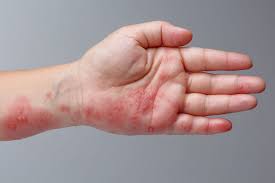 The Most Overlooked Shingles Symptoms You Need to Know About