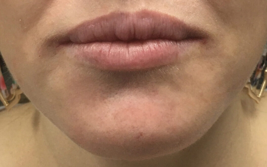 Boost Your Confidence with Sculptra Fillers