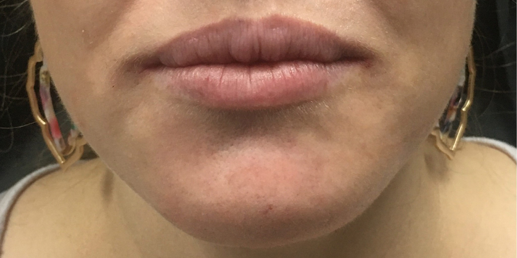 Smooth Fine Lines and Wrinkles with Sculptra