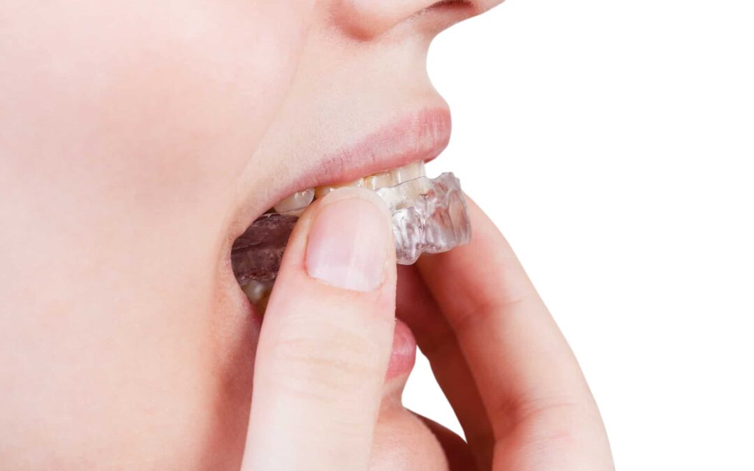 Teeth Grinding Treatment for Kids: What Parents Need to Know