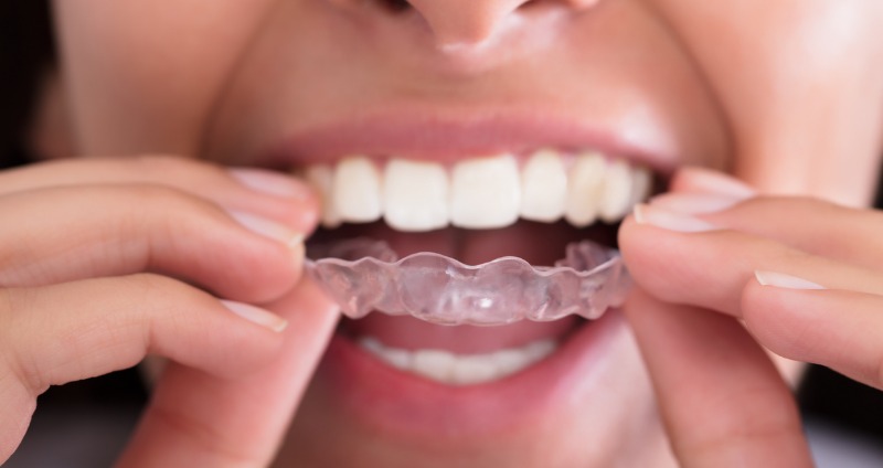 The Connection Between Retainers and Long-Term Teeth Alignment