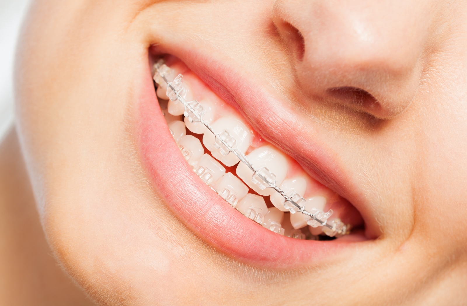 The Journey of Teeth Braces Before, During, and After Results