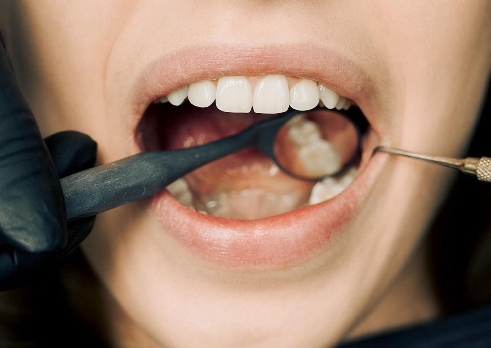 The Role of Tooth Extraction in Orthodontic Treatment