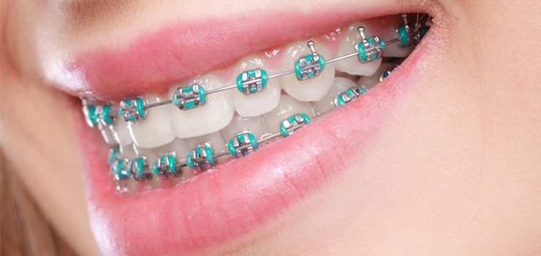 The Science Behind How Metal Braces Straighten Your Teeth