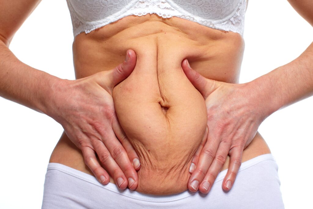 The Secret to a Sleeker SilhouetteLipoabdominoplasty Might Be It