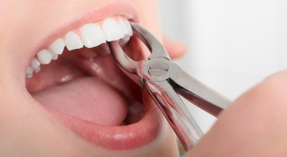 Tooth Removal and Dental Implants: Planning Your Next Step