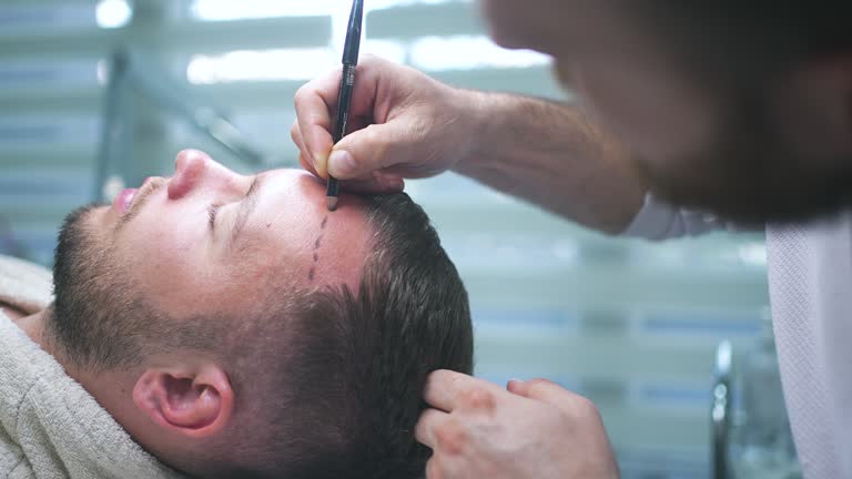 What Are the Benefits of Getting a Hair Transplant