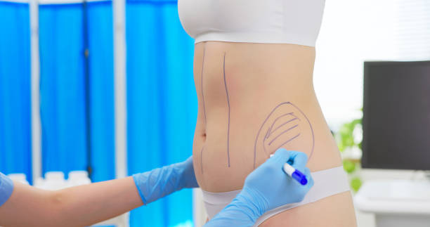 What Areas Can Liposuction Surgery Treat Safely