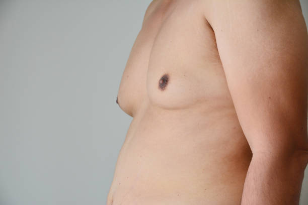 What Is Gynecomastia? Causes, Symptoms, and Treatment