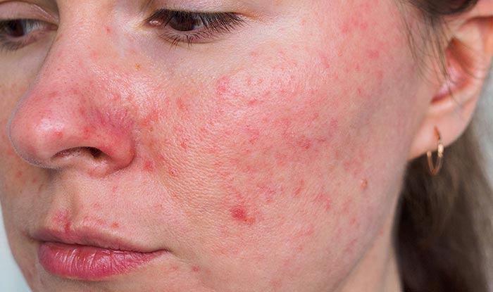What Professional Options Exist for Rosacea Treatment