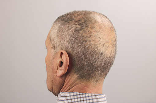 What to Expect After a Hair TransplantTimeline, Results & Care