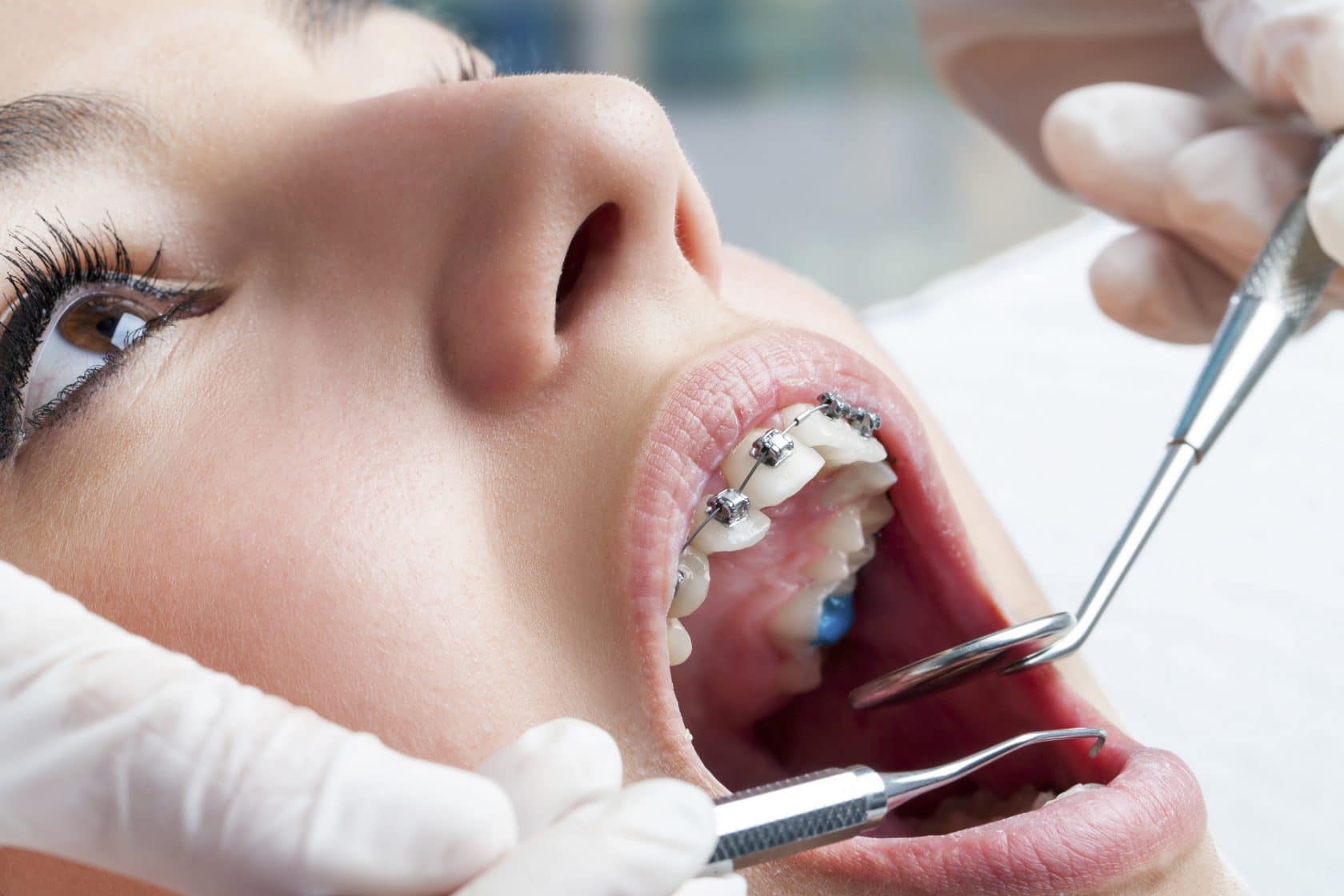 What to Expect at Your First Metal Braces Appointment