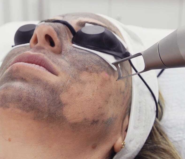 Laser Carbon Peel for Smooth and Even Skin