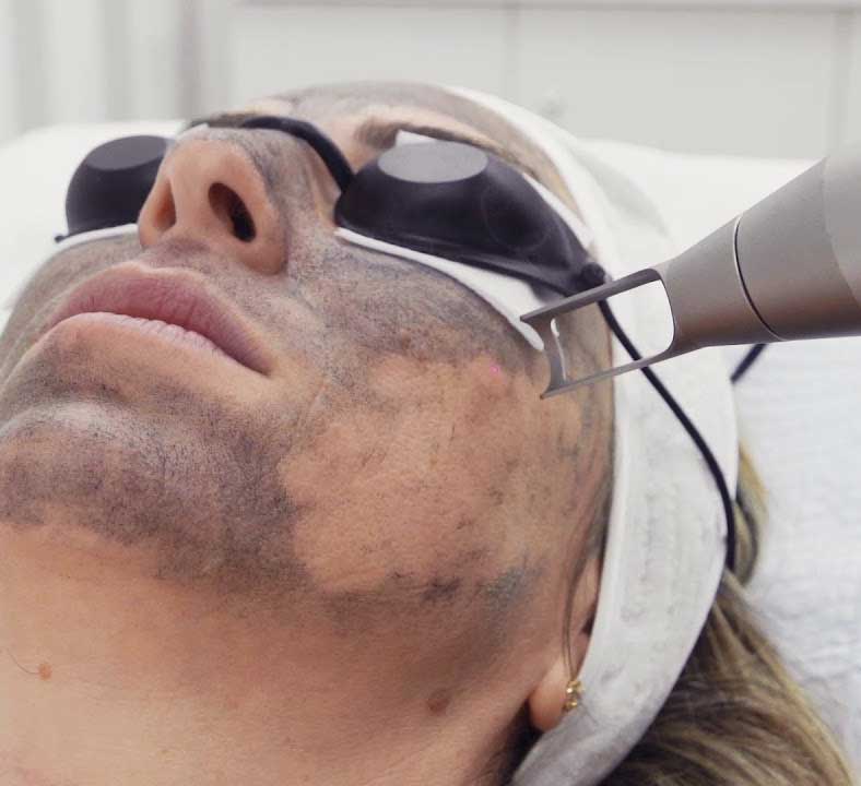 Achieve Glowing Skin with Laser Carbon Peel