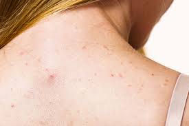 What Causes Back Acne and How to Treat It Safely at Home