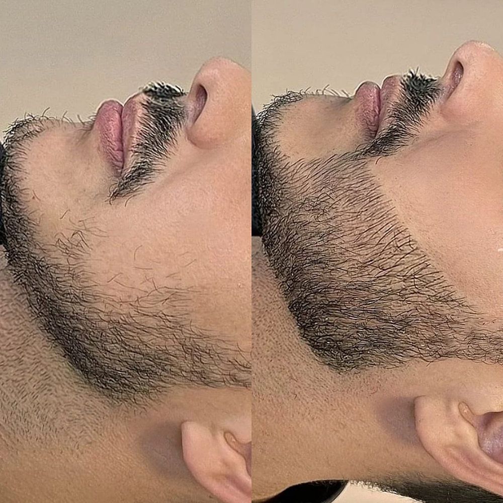 Beard hair transplant in dubai cost